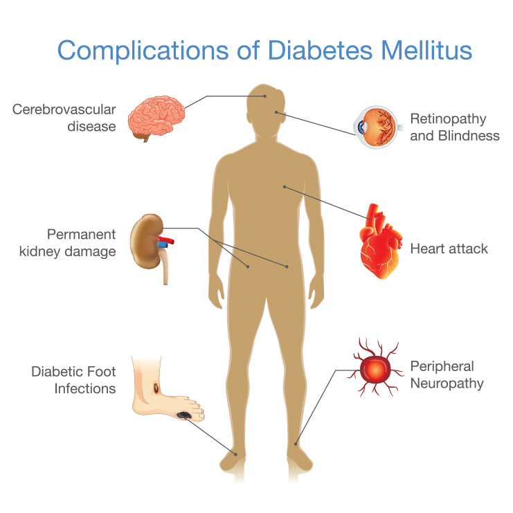 complications of diabetes mellitus